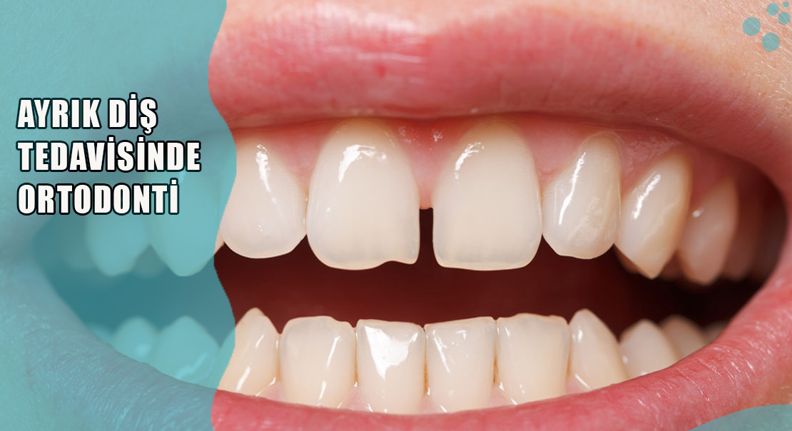 Ayrık Diş Tedavisinde Ortodonti