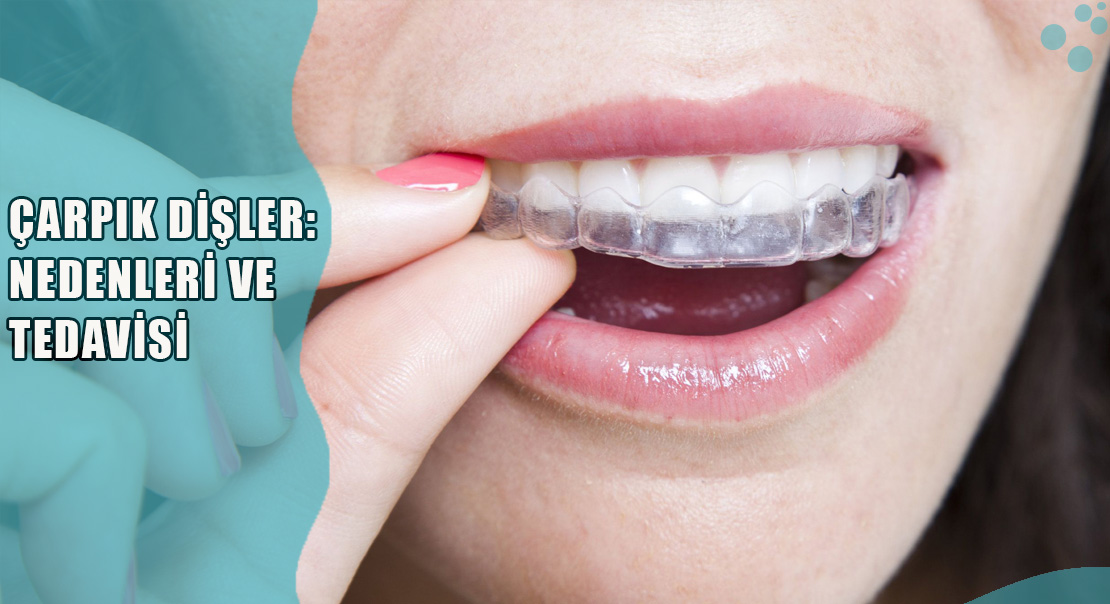 Çarpık Dişler: Nedenleri ve Tedavisi